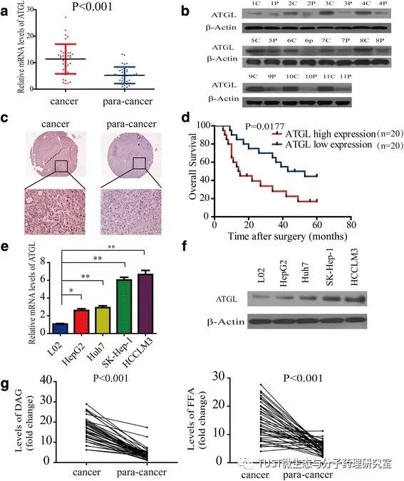 Mol Cancer：LncRNA NEAT1通过ATGL调控异常脂肪分解并促进肝癌增殖(图1)